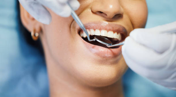 Best Lost Filling or Crown Replacement in New Port Richey, FL
